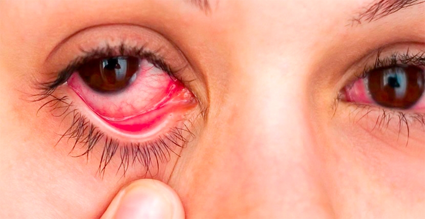 بیماری یوئیت چشم